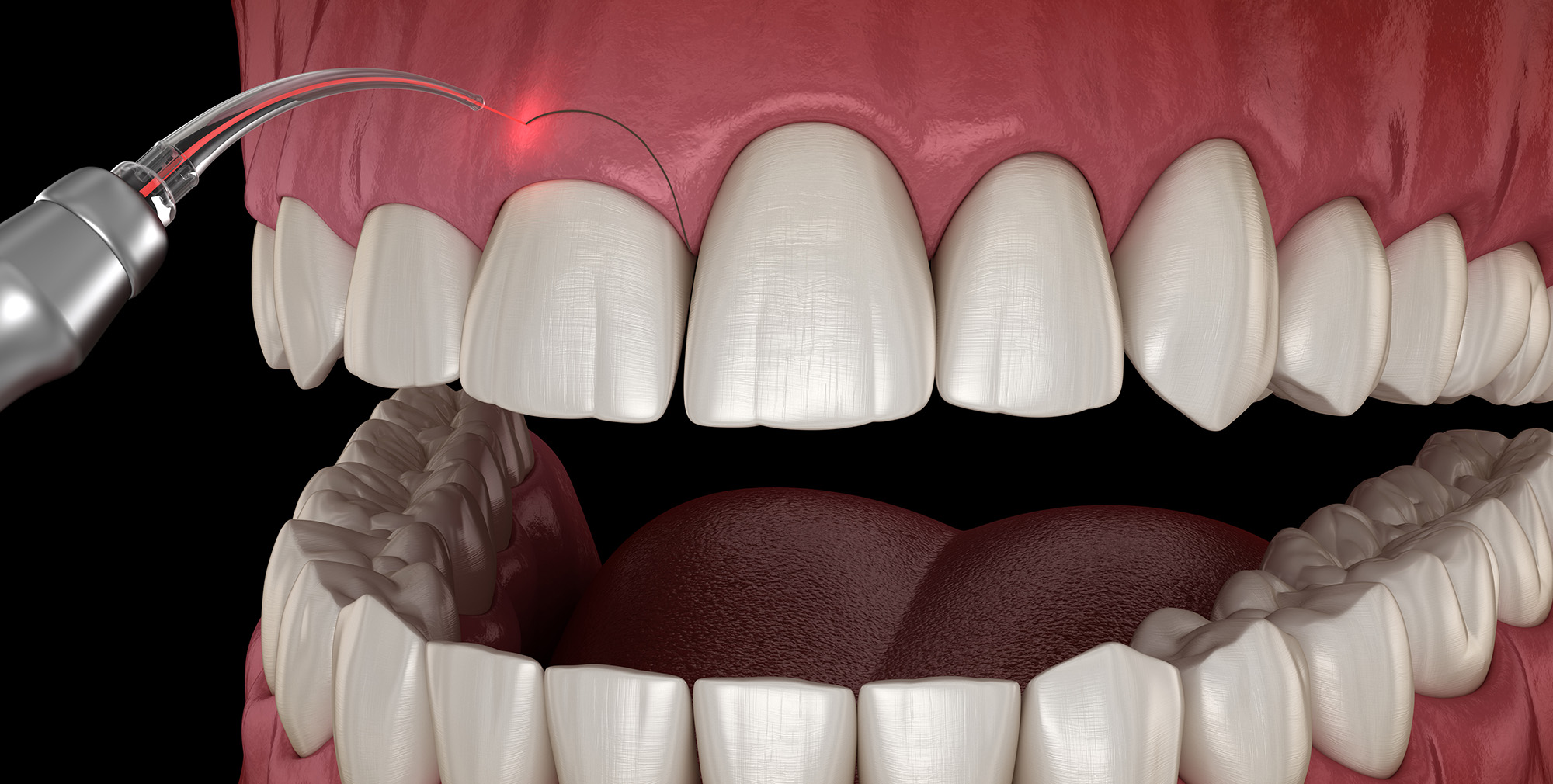 Gingivectomy Frenectomy Canton, OH Soft Tissue Treatment